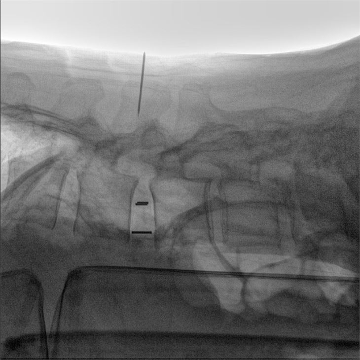 Digital Mobile X Ray Machine
